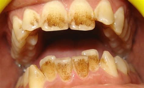 Does Spearmint Tea Stain Teeth? Exploring the Myths and Realities of Beverage-Induced Discoloration